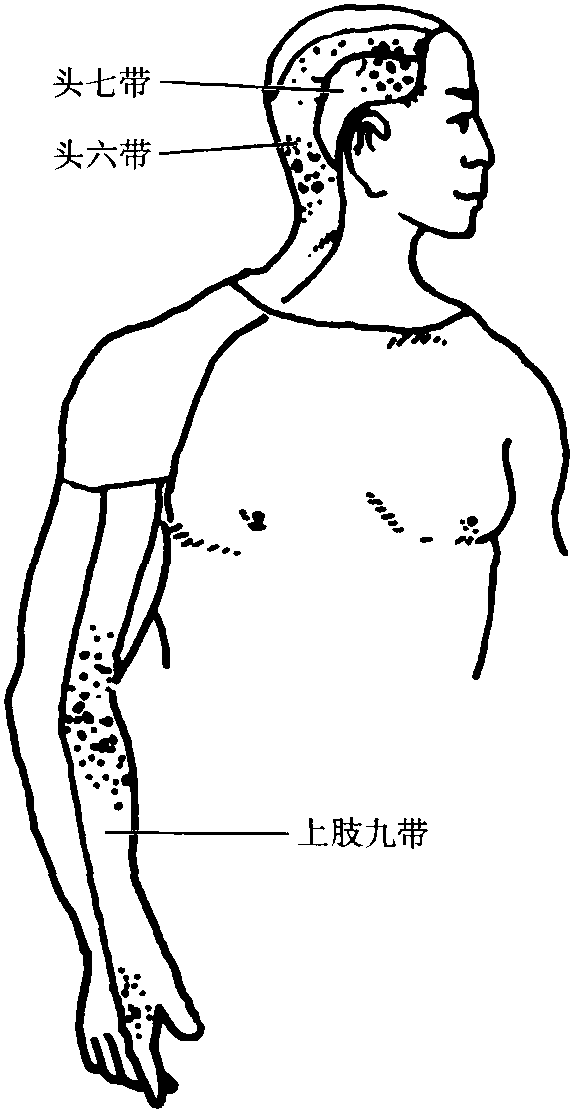 一、流行性感冒